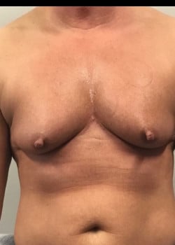 Before Image: FtM double incision mastectomy (DI) with nipple grafts for gender confirmation - front