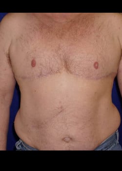After Image: Female to Male double incision mastectomy with nipple grafts for gender confirmation. - front