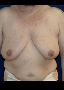 Before Image: Female to Male double incision mastectomy with nipple grafts for gender confirmation. - front
