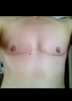 After Image: Female to Male double incision mastectomy (DI) with nipple grafts for gender confirmation. - front