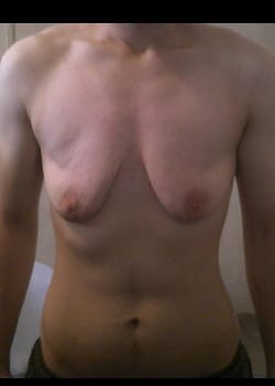 Before Image: Female to Male double incision mastectomy (DI) with nipple grafts for gender confirmation. - front
