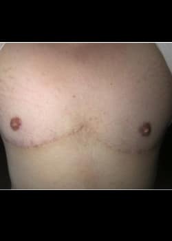 After Image: Female to Male top surgery (DI) with nipple grafts for gender confirmation. - front