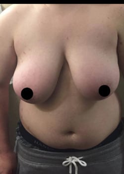 Before Image: Female to Male top surgery (DI) with nipple grafts for gender confirmation. - front