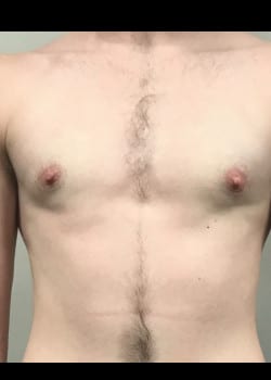 After Image: FtM peri-areolar mastectomy for gender confirmation - front