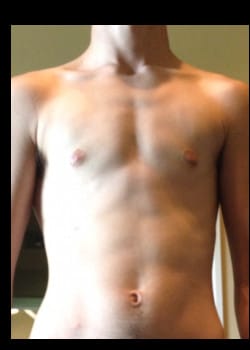 After Image: Female to Male peri-areolar top surgery for gender confirmation. - front