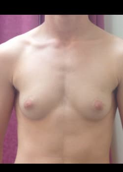 Before Image: Female to Male peri-areolar top surgery for gender confirmation. - front