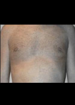After Image: Female to Male peri-areolar top surgery for gender confirmation. - front