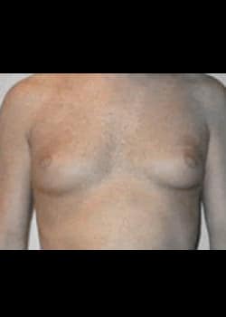 Before Image: Female to Male peri-areolar top surgery for gender confirmation. - front