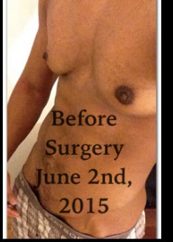 Before Image: Gender confirmation top surgery - front