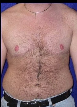 After Image: FtM Top Surgery via double incision (DI) approach - front