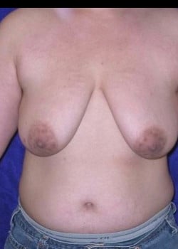 Before Image: FtM Top Surgery via double incision (DI) approach - front