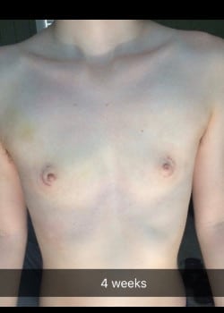 After Image: Gender Confirmation top surgery via a peri-areolar approach before and after - front