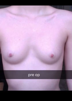 Before Image: Gender Confirmation top surgery via a peri-areolar approach before and after - front