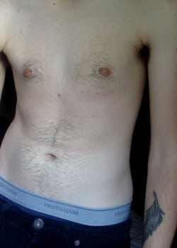 After Image: Gender Confirmation top surgery via a peri-areolar approach before and after - front