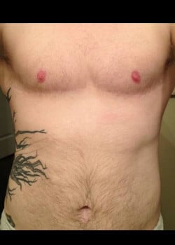 After Image: Gender Confirmation top surgery via a double incision with nipple grafting - front