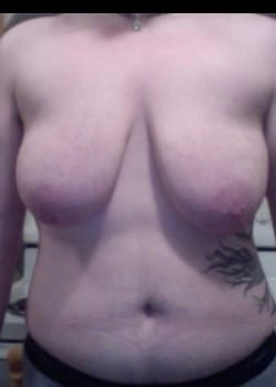 Before Image: Gender Confirmation top surgery via a double incision with nipple grafting - front