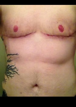 After Image: Gender Confirmation top surgery via a double incision with nipple grafting - front