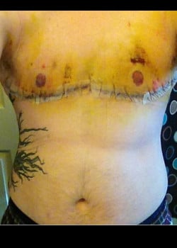 Before Image: Gender Confirmation top surgery via a double incision with nipple grafting - front