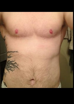After Image: Gender Confirmation top surgery via a double incision with nipple grafting - front