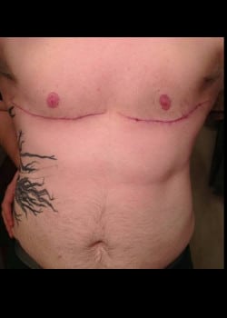 Before Image: Gender Confirmation top surgery via a double incision with nipple grafting - front