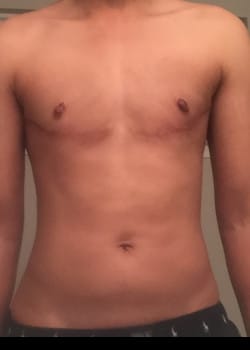 After Image: FtM top Surgery via double incision and nipple grafting - front