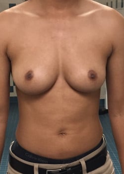 Before Image: FtM top Surgery via double incision and nipple grafting - front