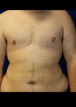 After Image: Gender confirmation top surgery via double incision with nipple grafting - front