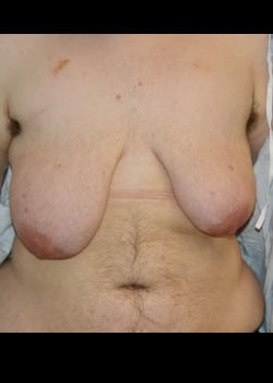 Before Image: Gender confirmation top surgery via double incision with nipple grafting - front