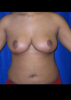 After Image: Breast reduction and lift - front