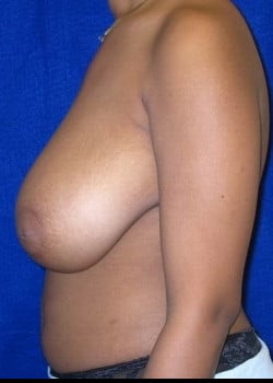 Before Image: Breast reduction and lift - front