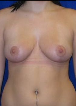 After Image: Breast Reduction and Lift - front