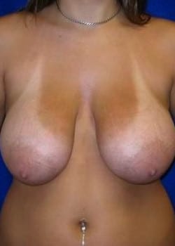 Before Image: Breast Reduction and Lift - front