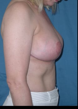 After Image: Bilateral Breast Reduction and Lift - front