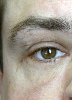 After Image: Lower lid blepharoplasty before and after - front