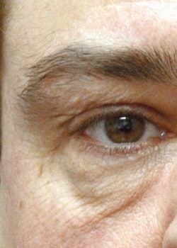 Before Image: Lower lid blepharoplasty before and after - front
