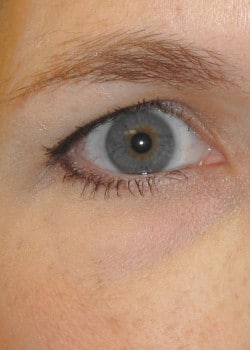 After Image: Lower lid blepharoplasty with fat removal - front