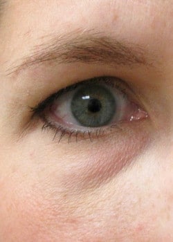 Before Image: Lower lid blepharoplasty with fat removal - front