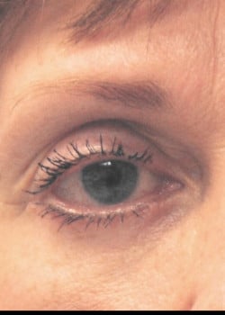 After Image: Lower lid blepharoplasty before and after - front