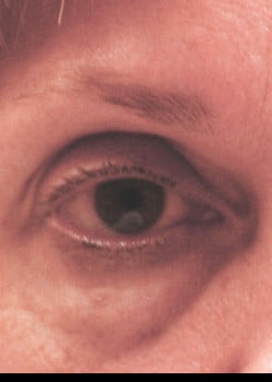 Before Image: Lower lid blepharoplasty before and after - front