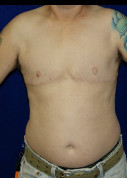 After Image: Gender Confirmation Surgery (Double incision with nipple grafts) - front