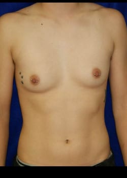 Before Image: FtM Peri- areolar top surgery for Gender Confirmation - front