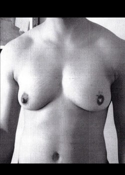 Before Image: Double incision and nipple grafting for gender confirming top surgery - front
