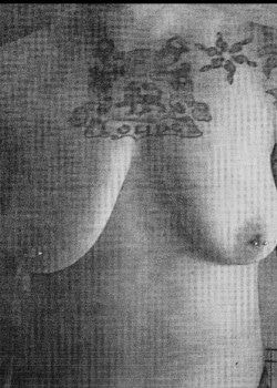 Before Image: Double Incision mastectomy with nipple grafts for gender confirmation top surgery - front
