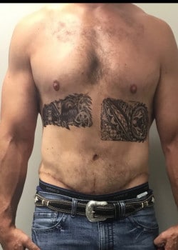 After Image: GYNECOMASTIA REDUCTION AND TUMMY TUCK AFTER MASSIVE WEIGHT LOSS - front