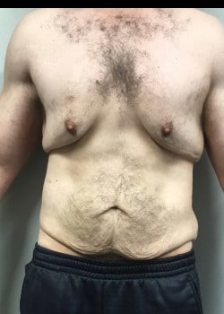 Before Image: GYNECOMASTIA REDUCTION AND TUMMY TUCK AFTER MASSIVE WEIGHT LOSS - front