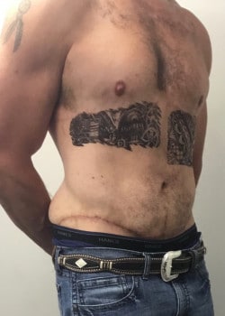 After Image: GYNECOMASTIA REDUCTION AND TUMMY TUCK AFTER MASSIVE WEIGHT LOSS - front