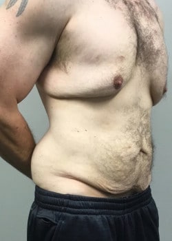 Before Image: GYNECOMASTIA REDUCTION AND TUMMY TUCK AFTER MASSIVE WEIGHT LOSS - front