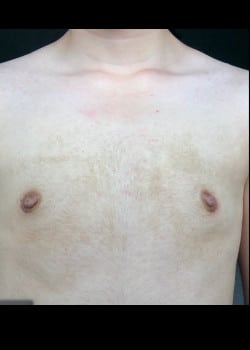 After Image: Gender Confirmation Top Surgery via a peri-areolar approach - front