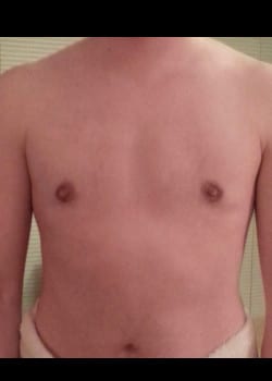 After Image: Gender Confirmation Top Surgery via a Peri-areolar approach - front