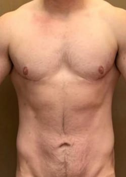 After Image: FtM DI top surgery for gender affirmation with body contouring (lower abdominoplasty and liposuction) - front